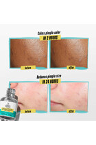 Truly Targeted Acne Clearing Spot Treatment Solution